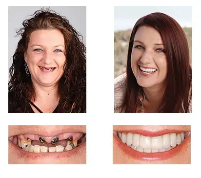 Custom-Fit Dentures | Self-Molding & Natural Smile - Image 5