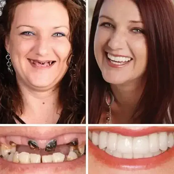 -Ends Today: 70% OFF! Full Denture with Strong Suctiond Custom-Fit Full Functional Dentures🦷 - Image 7