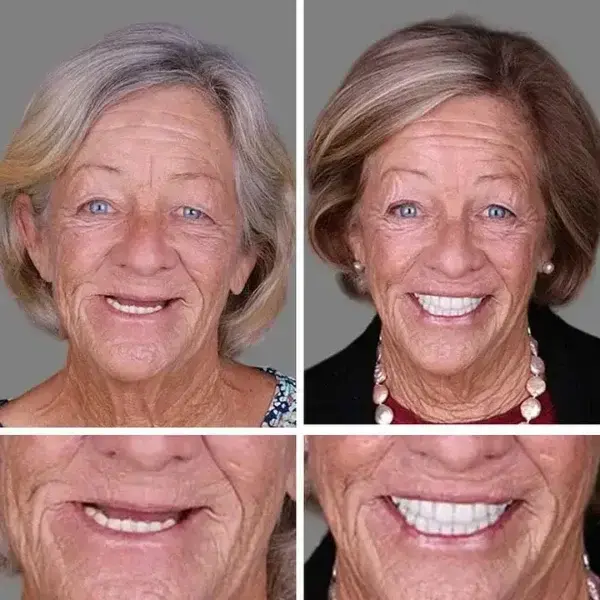 Full Denture with Strong Suction – 2026 Comfort Fit - Image 6