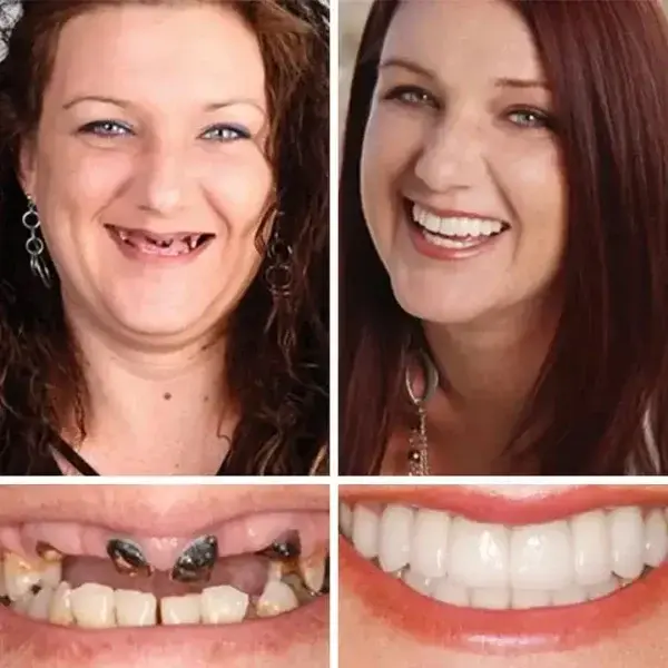 Full Denture with Strong Suction – 2026 Comfort Fit - Image 7