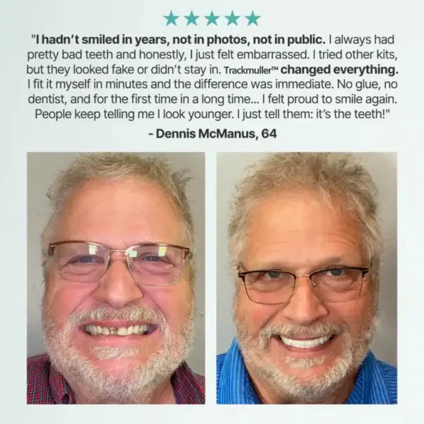 🌎Ends Today: 70% OFF! Full Denture with Strong Suctiond - Image 12