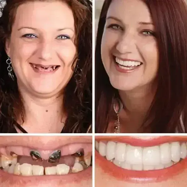 Premium Full Denture Set - Image 11