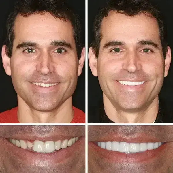 Premium Full Denture Set - Image 9