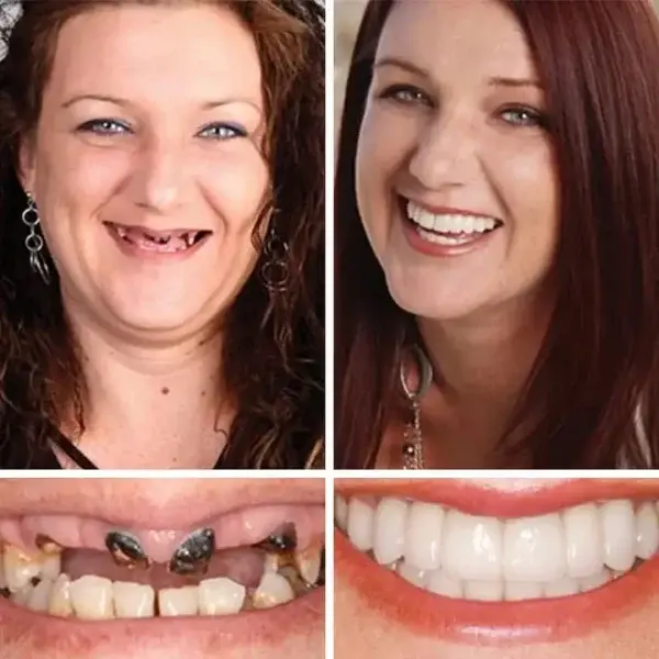 Custom-Fit Dentures - Image 10