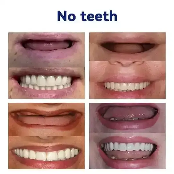 Advanced Customized Full Denture Set - Image 8