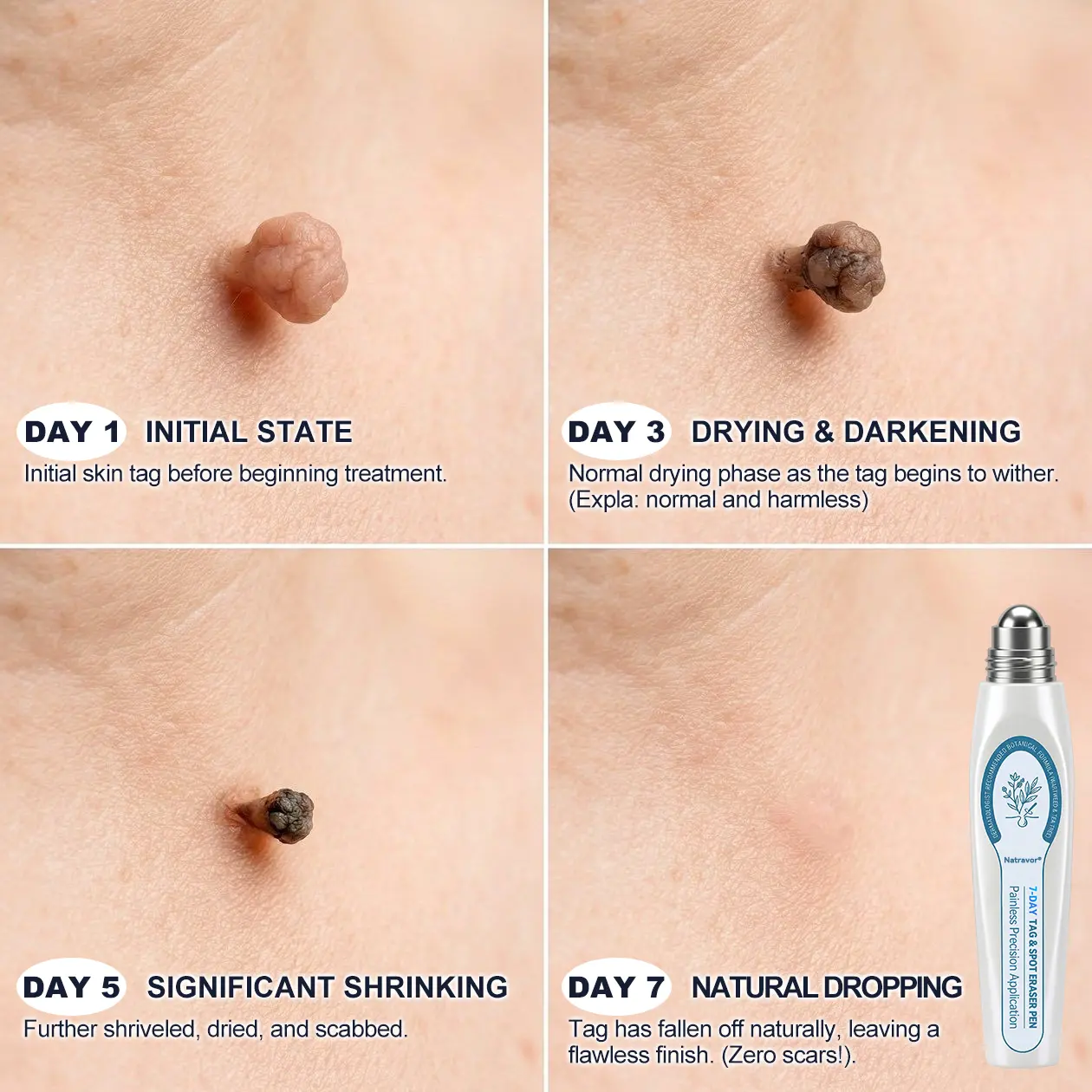 7-Day Skin Tag & Spot Eraser Painless & Scar-Free Advanced Skin Renewal Roller Pen - Image 4