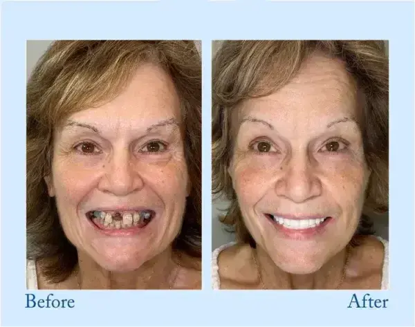 Dentures - Image 12
