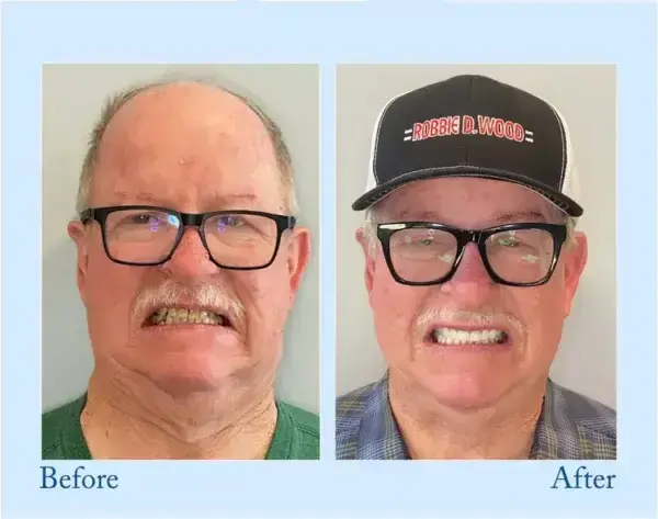 Dentures - Image 8