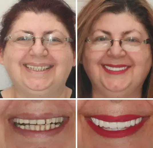 🌟 – Custom-Crafted Dentures That Feel as Natural as They Look👩🔬 - Image 10