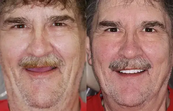 🌟 – Custom-Crafted Dentures That Feel as Natural as They Look👩🔬 - Image 12