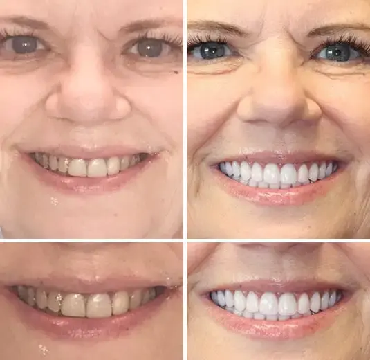 🌟 – Custom-Crafted Dentures That Feel as Natural as They Look👩🔬 - Image 9