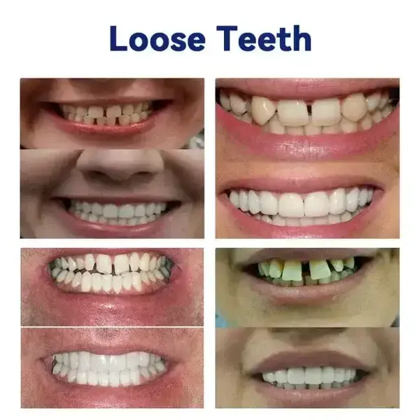 Ease Dentures - Image 6