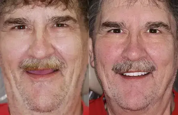 PREMIUM DENTURES - Image 11