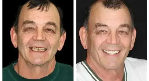 PREMIUM DENTURES - Image 12