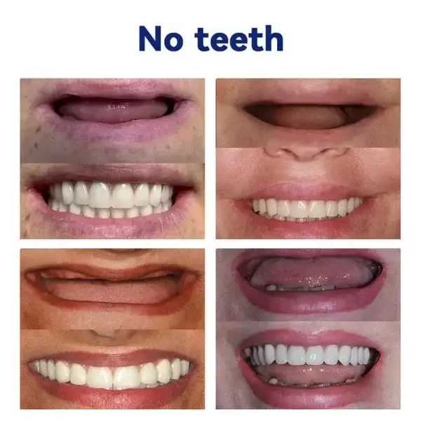 Advanced Full Denture Set - Image 9