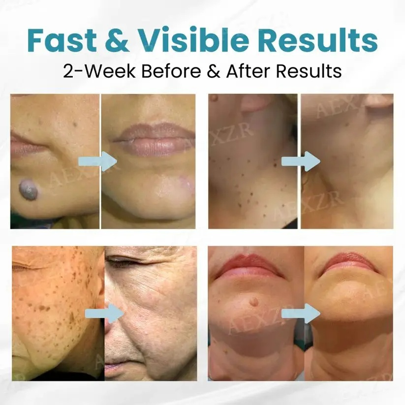 Non-Invasive Mole and Wart Removal Laser Pen - Image 11