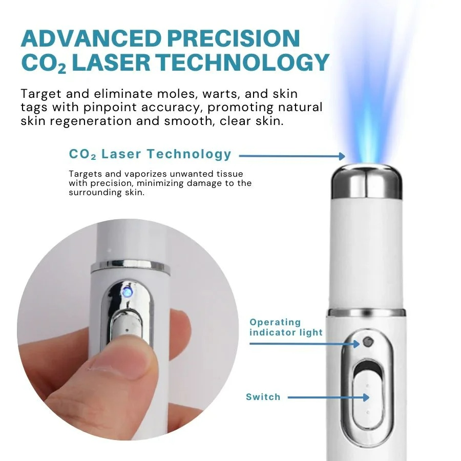 Non-Invasive Mole and Wart Removal Laser Pen - Image 2