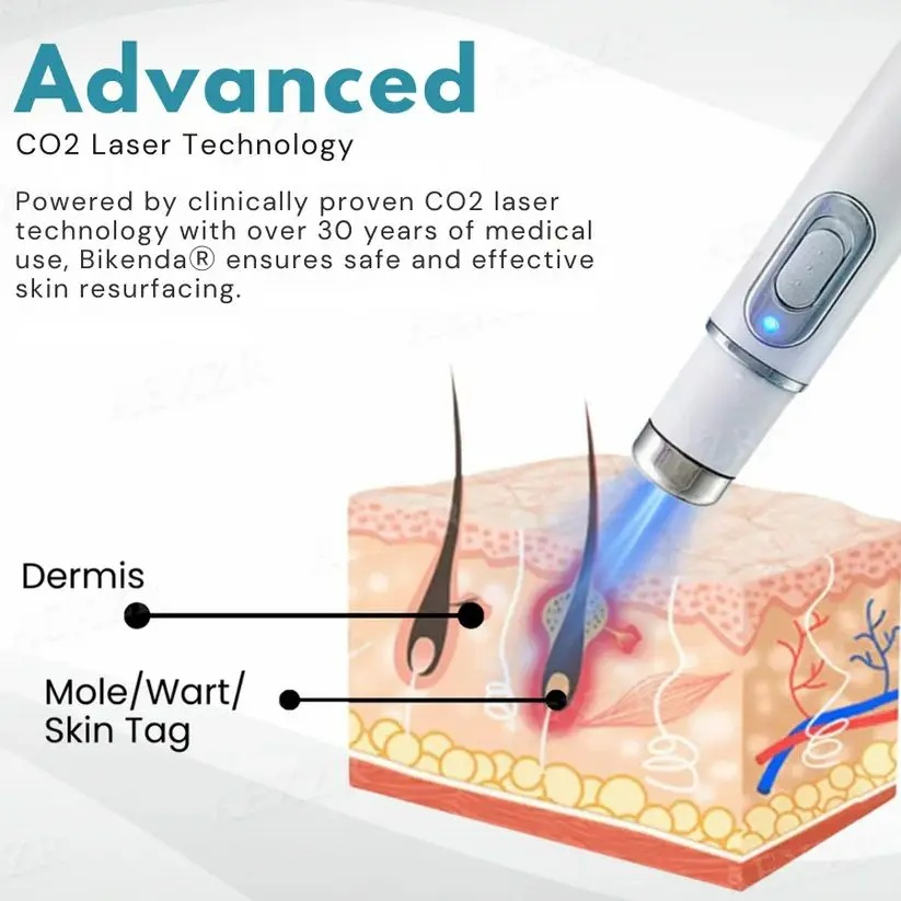 Non-Invasive Mole and Wart Removal Laser Pen - Image 4