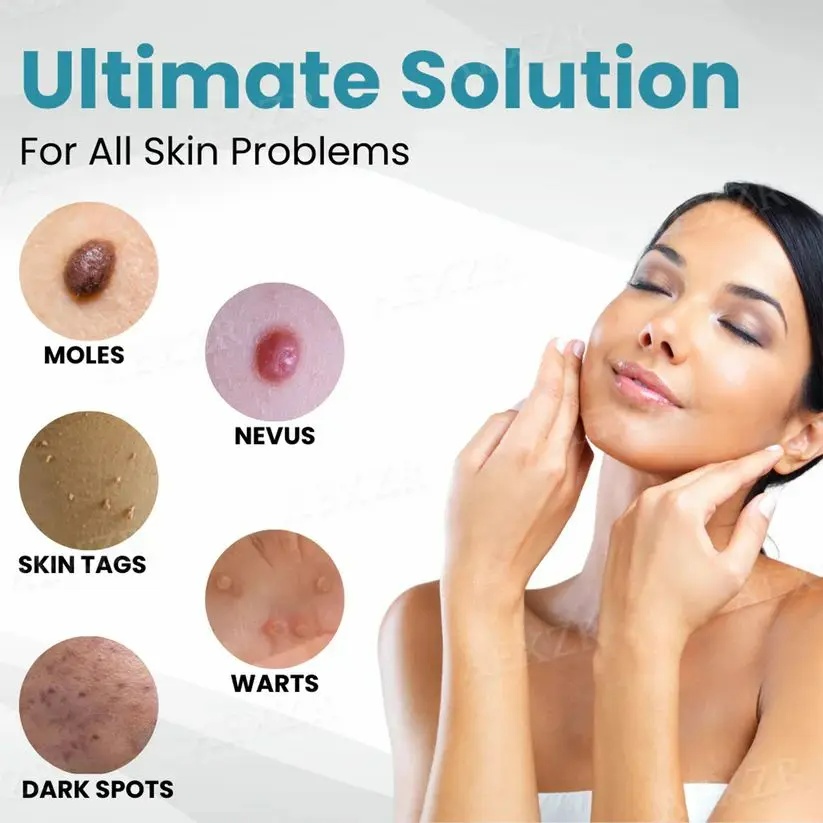 Non-Invasive Mole and Wart Removal Laser Pen - Image 6