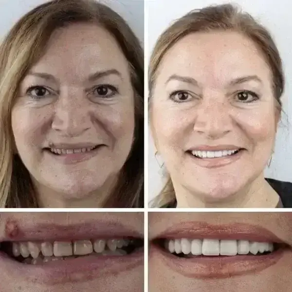 -Ends Today: 70% OFF! Full Denture with Strong Suctiond Custom-Fit Full Functional Dentures🦷 - Image 4