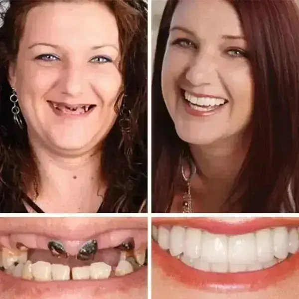 -Ends Today: 70% OFF! Full Denture with Strong Suctiond Custom-Fit Full Functional Dentures🦷 - Image 6