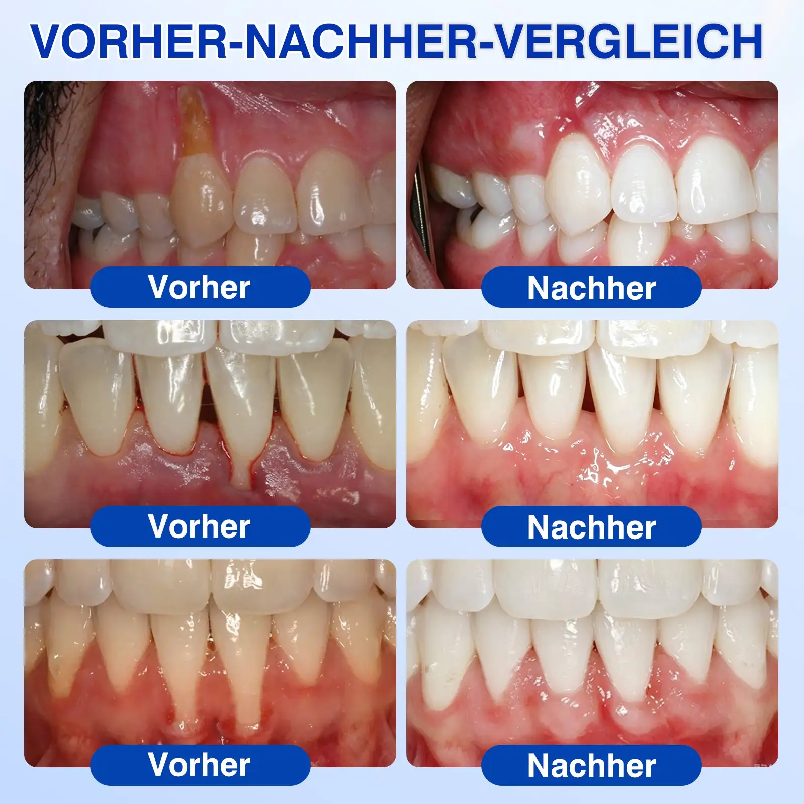 GumRevive Parodontales Reparaturgel - Image 3