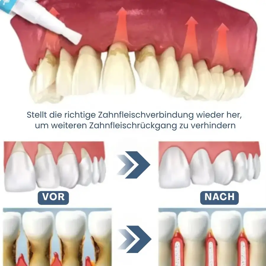 Zahnfleisch Sofort-Gel - Image 2
