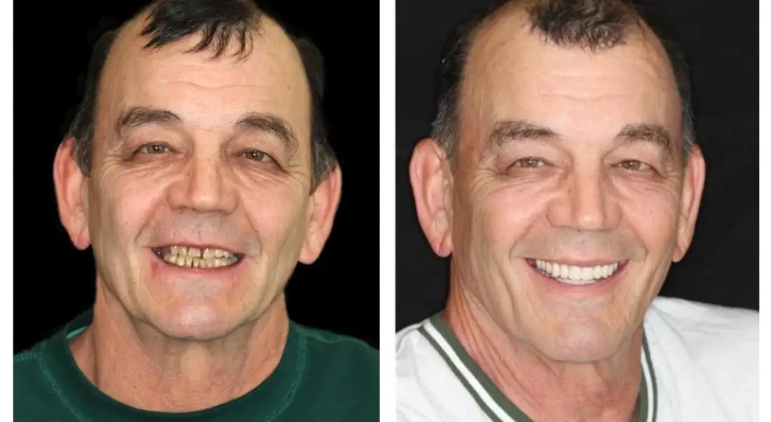 Custom-Fit Premium Dentures – Full Set - Image 11