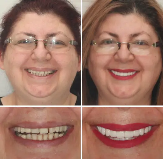 Custom-Fit Premium Dentures – Full Set - Image 8