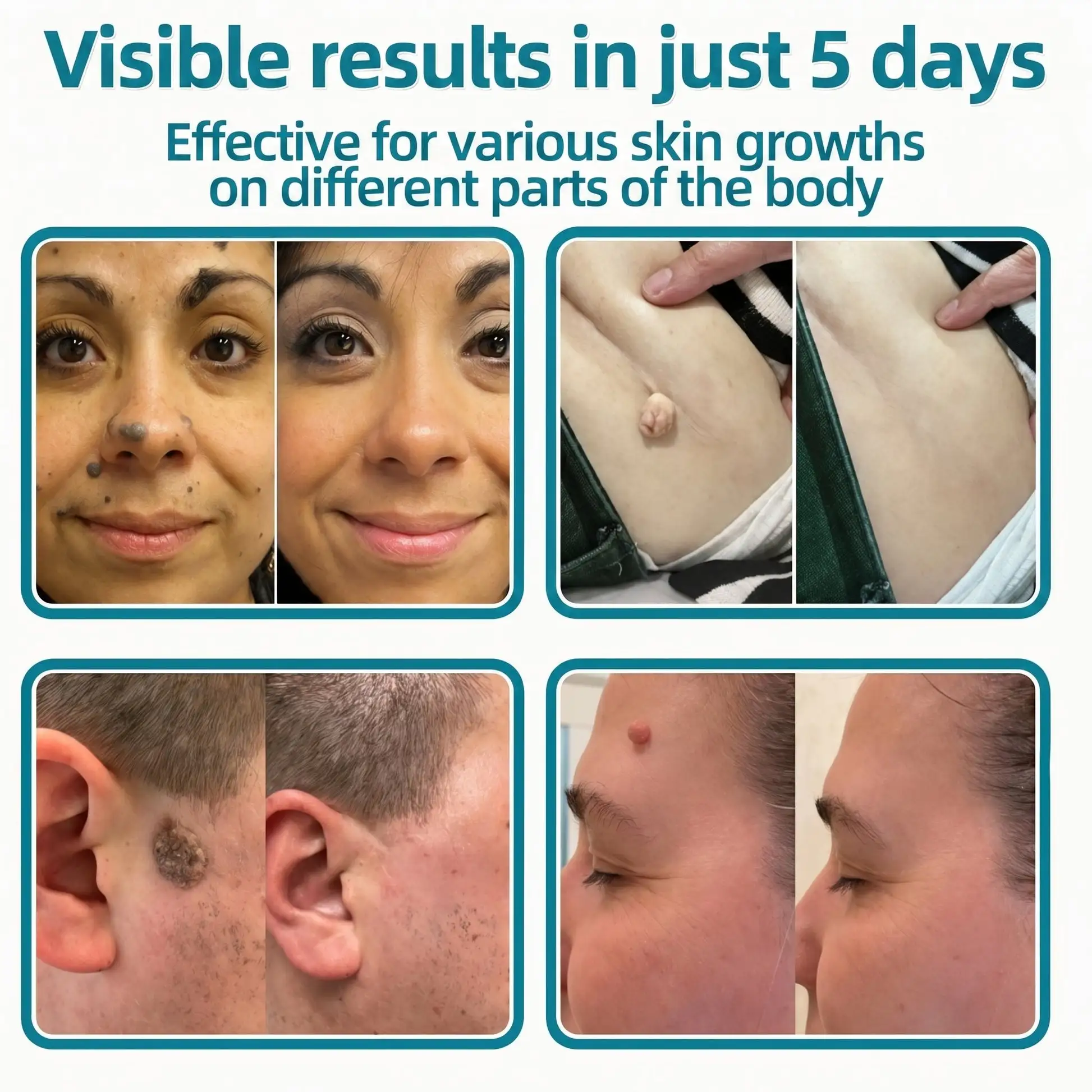2-in-1 Microneedle & Hydrocolloid Patch - Image 3