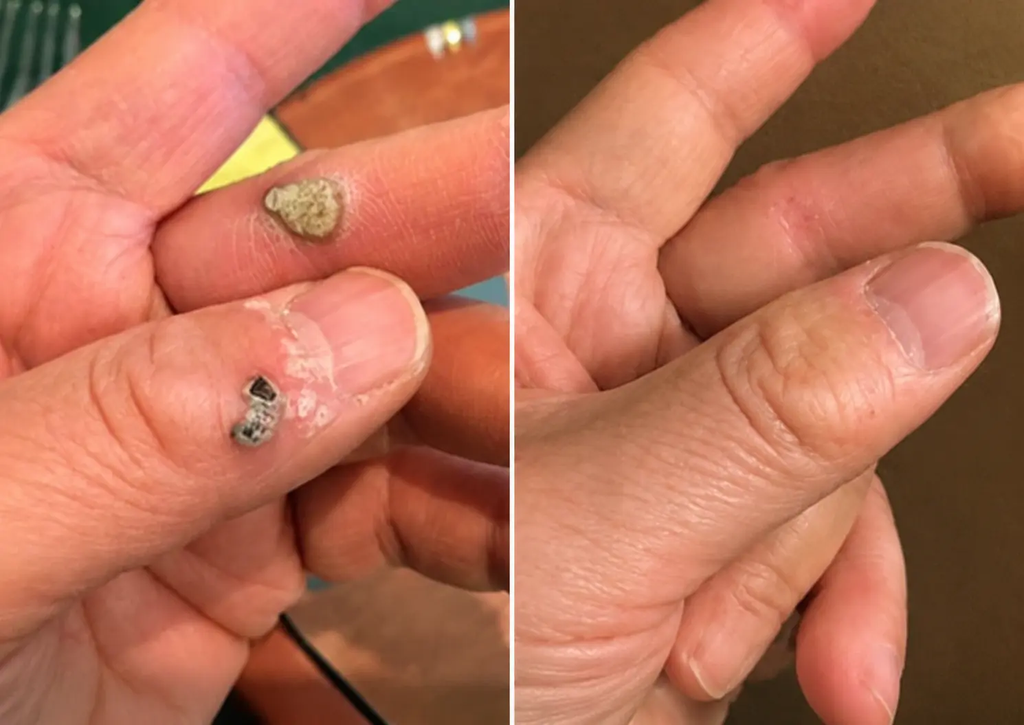 2-in-1 Microneedle & Hydrocolloid Patch - Image 6