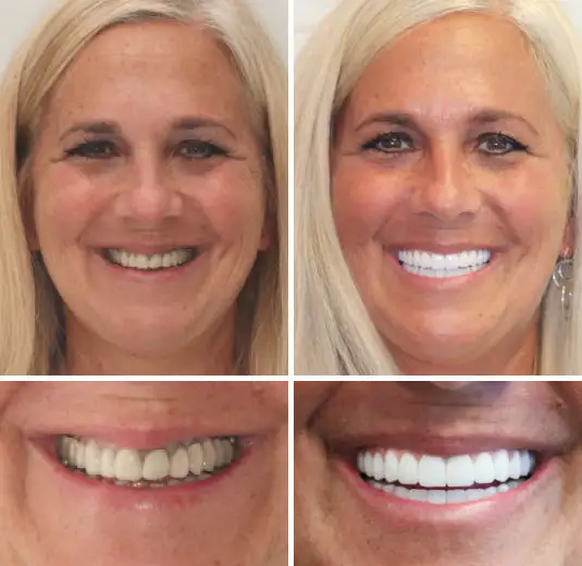 Full Denture Setš¦·š¦·šAdvanced Self-Adjusting Dental Materials (ā°Limited time discount last 30 minutesā°) - Image 5