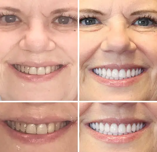 Full Denture Setš¦·š¦·šAdvanced Self-Adjusting Dental Materials (ā°Limited time discount last 30 minutesā°) - Image 6