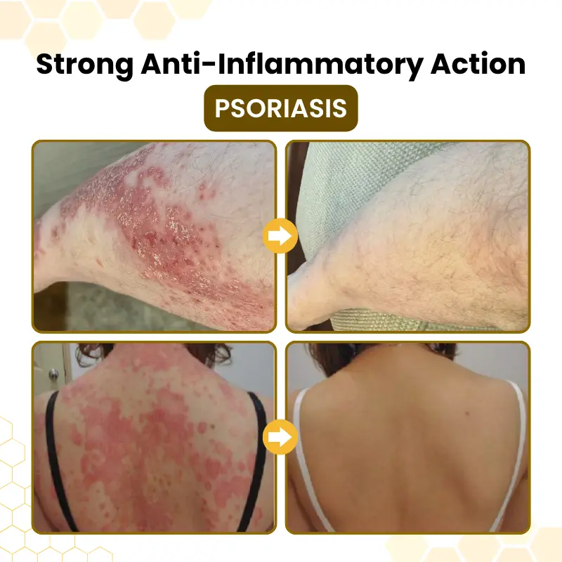 PsoriaSoothe Skin Care Cream - Image 6