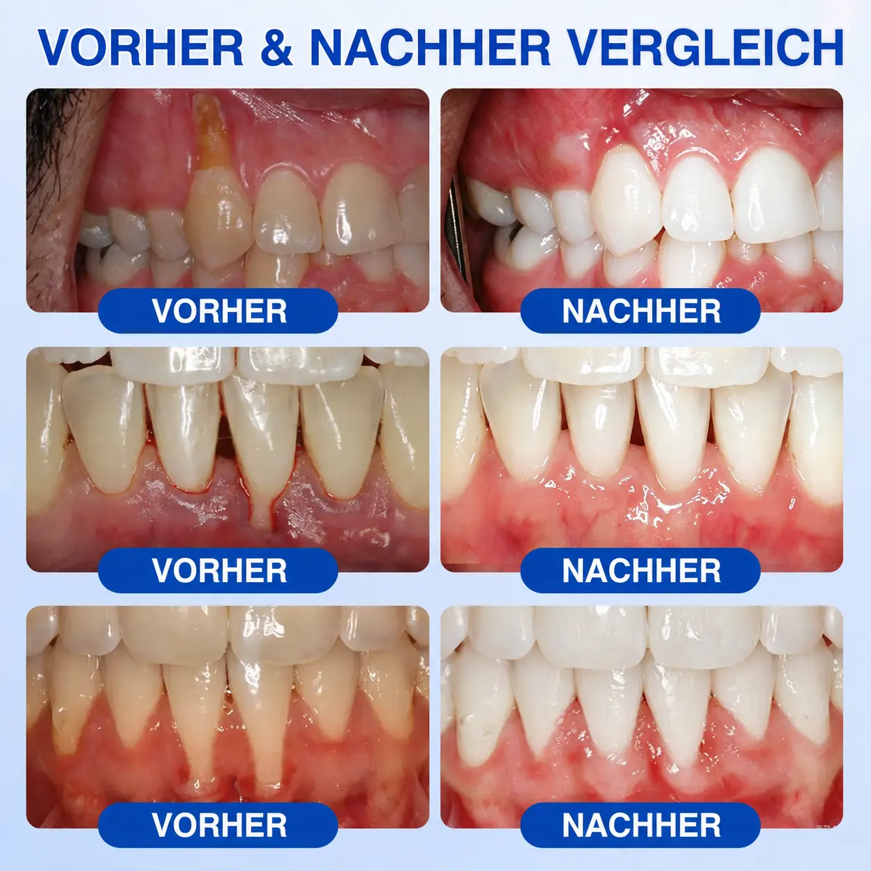 GumCare Pro | Zahnfleischpflege & Parodontal Gel - Image 2