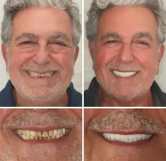 【Official Brand Store】Custom-Fit Functional Dentures — ComfortMax Edition - Image 10