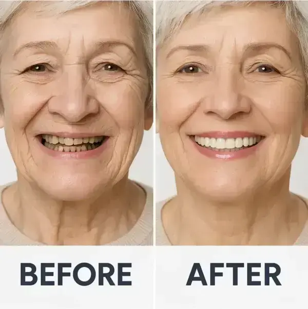 【Official Brand Store】Custom-Fit Functional Dentures — ComfortMax Edition - Image 12