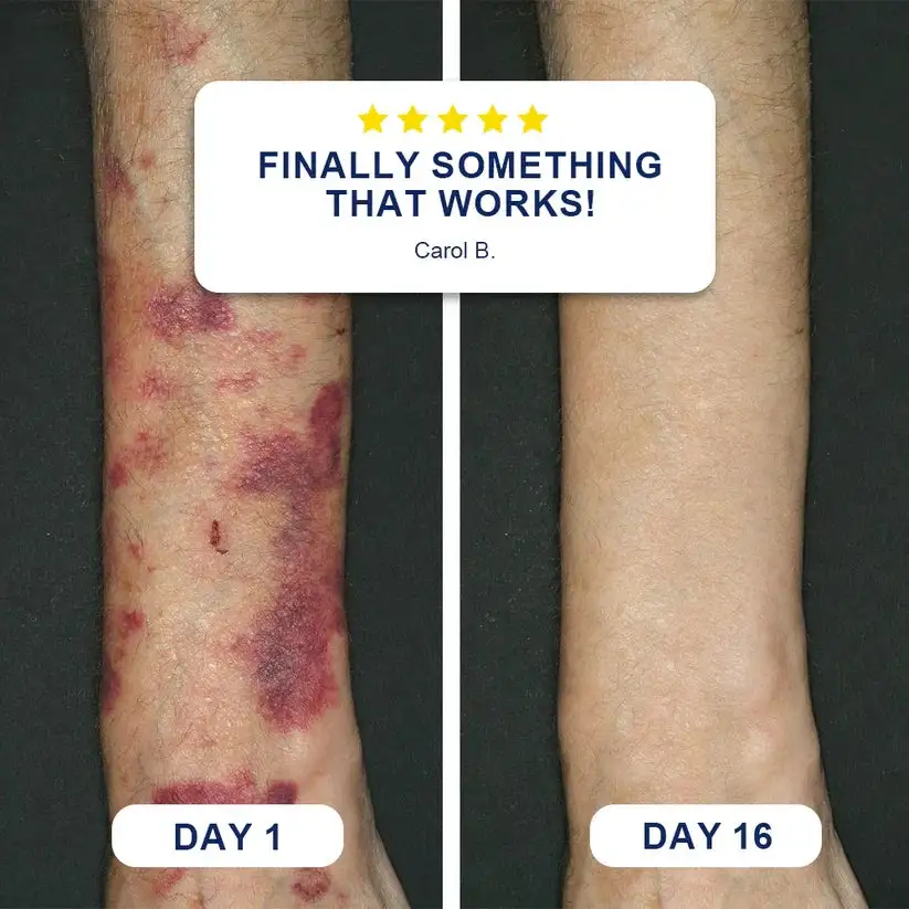🏆Official US Bruise Repair & Skin-Strengthening Cream - Image 2