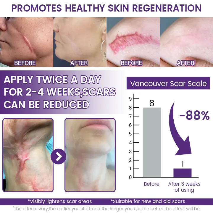 Stem Cell Scar Gel | Silicone Scar Care Gel for Old & New Scars - Image 2