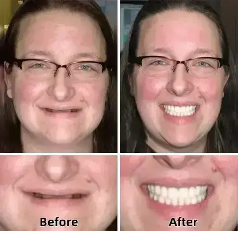 Custom Fit Dentures - Image 4