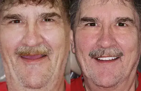 Premium Dentures - Image 5