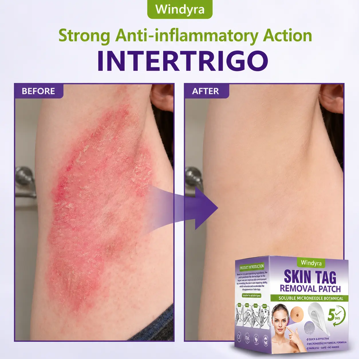 Soluble Microneedle Botanical Skin Tag Removal Patch - Image 10