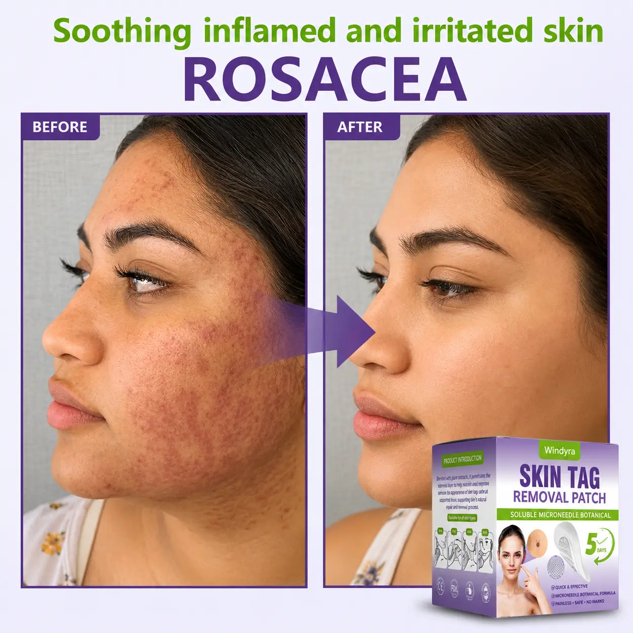 Soluble Microneedle Botanical Skin Tag Removal Patch - Image 11