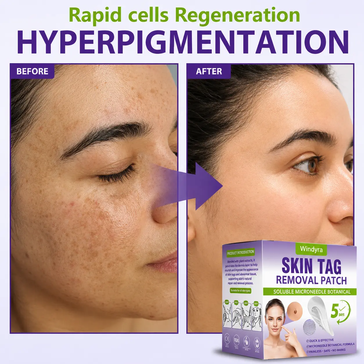Soluble Microneedle Botanical Skin Tag Removal Patch - Image 12