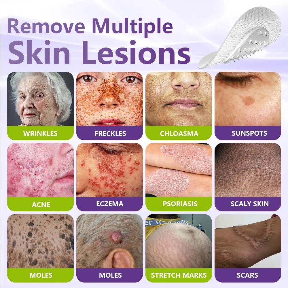 Soluble Microneedle Botanical Skin Tag Removal Patch - Image 2