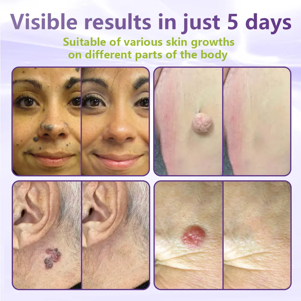 Soluble Microneedle Botanical Skin Tag Removal Patch - Image 3