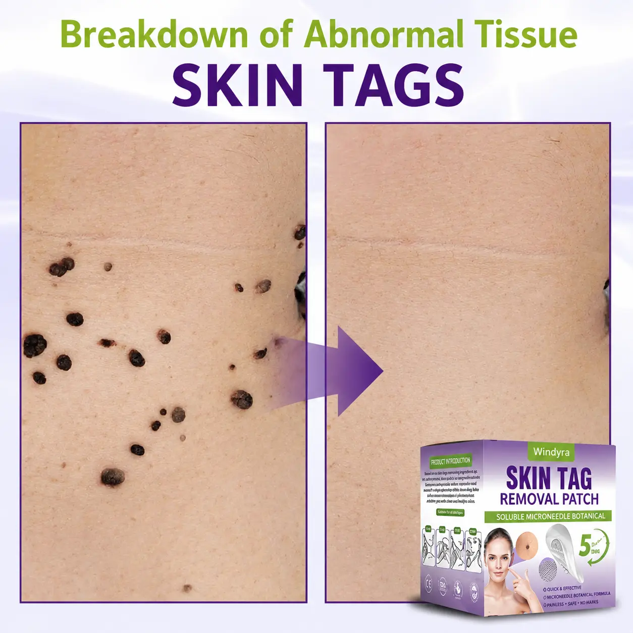 Soluble Microneedle Botanical Skin Tag Removal Patch - Image 5