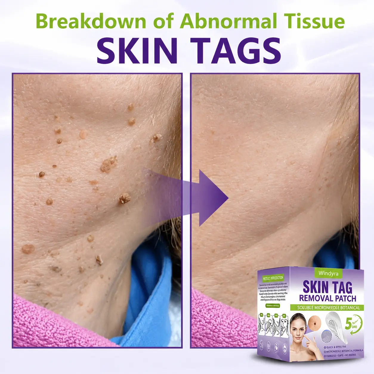 Soluble Microneedle Botanical Skin Tag Removal Patch - Image 6