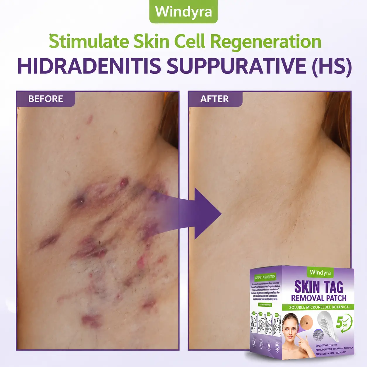 Soluble Microneedle Botanical Skin Tag Removal Patch - Image 7