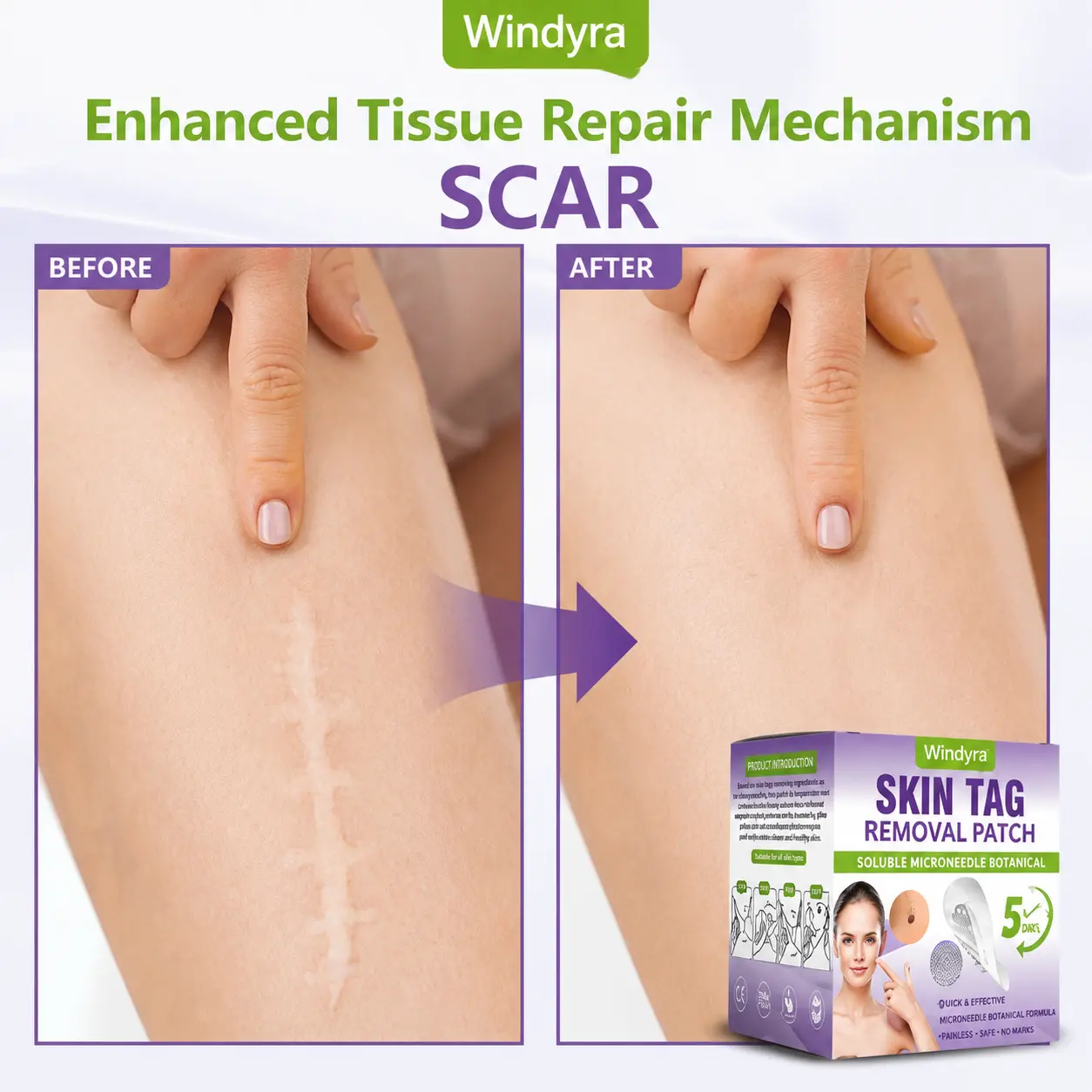 Soluble Microneedle Botanical Skin Tag Removal Patch - Image 9